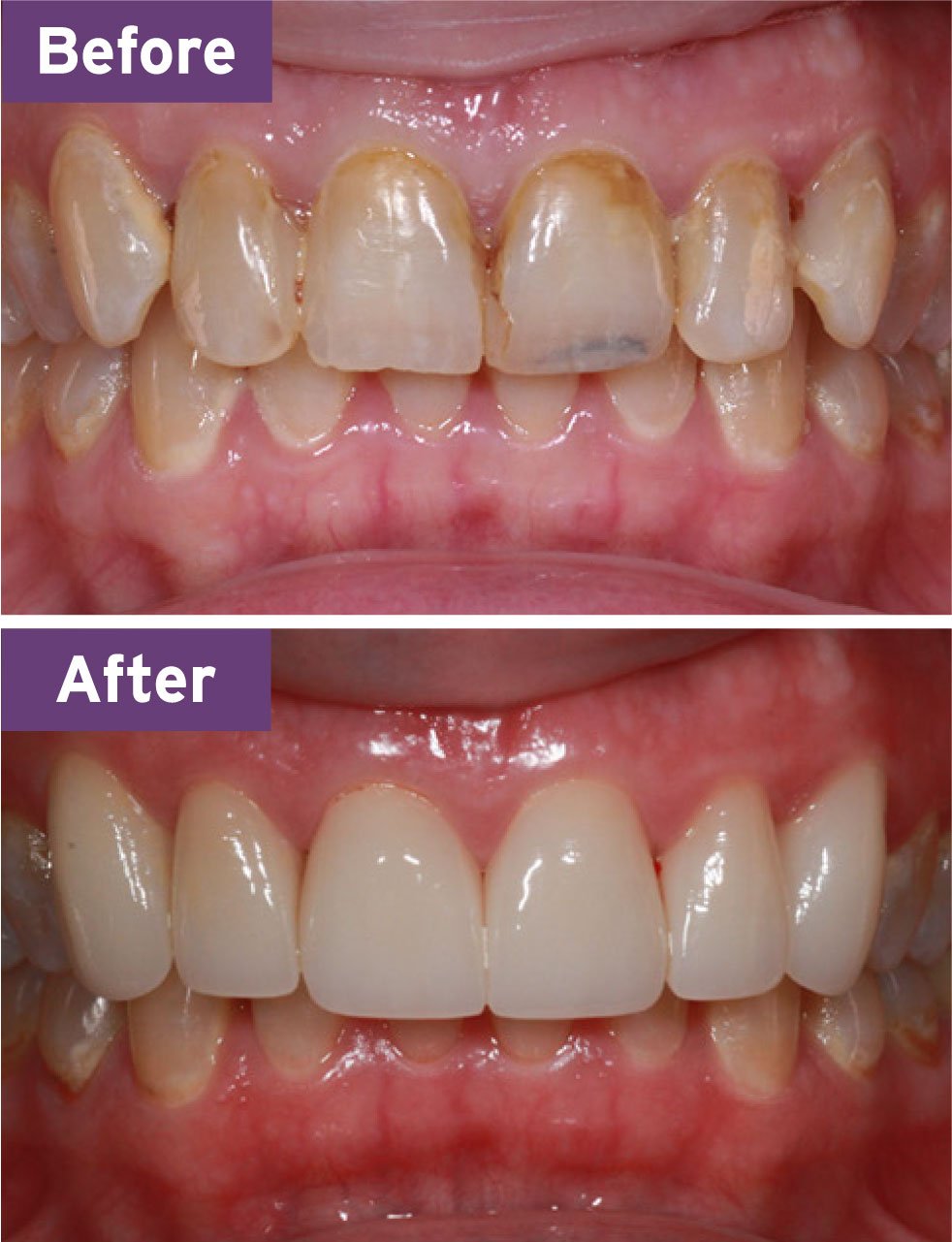 Lynnwood Dentist Smile Gallery