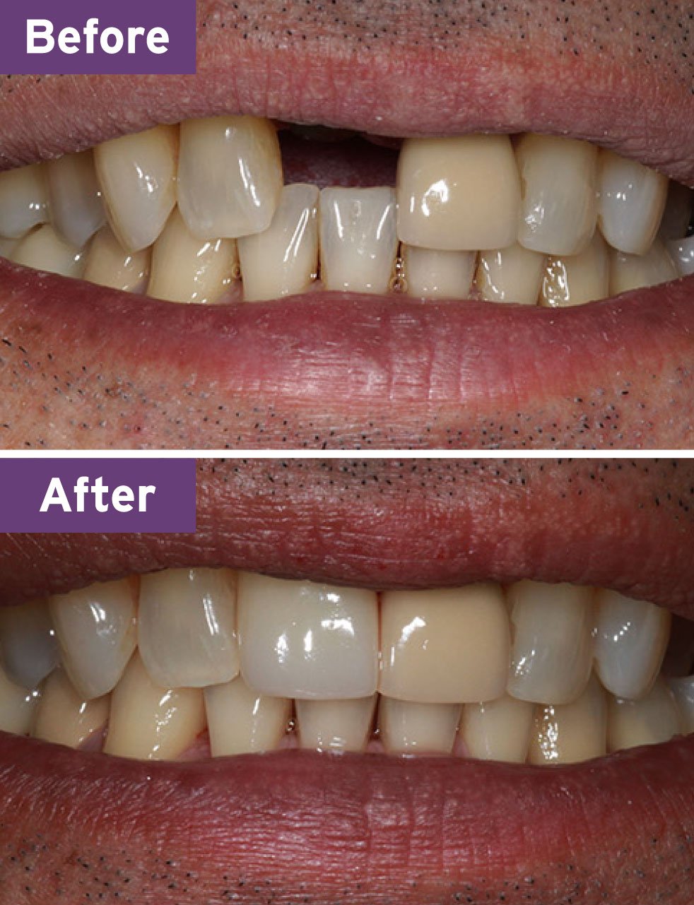 Lynnwood Dentist Smile Gallery