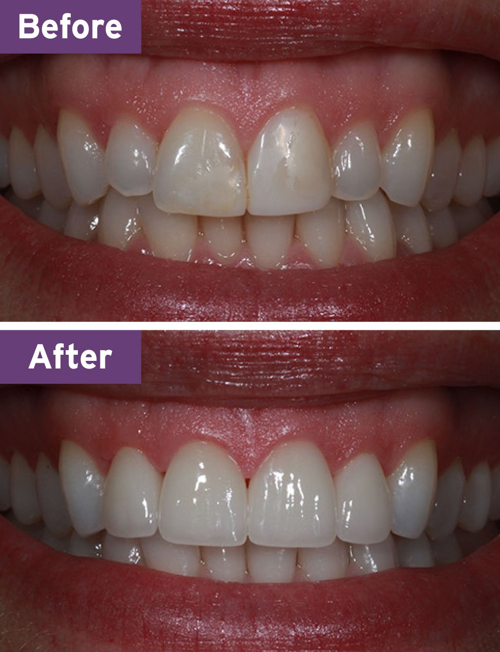 Lynnwood Dentist Smile Gallery
