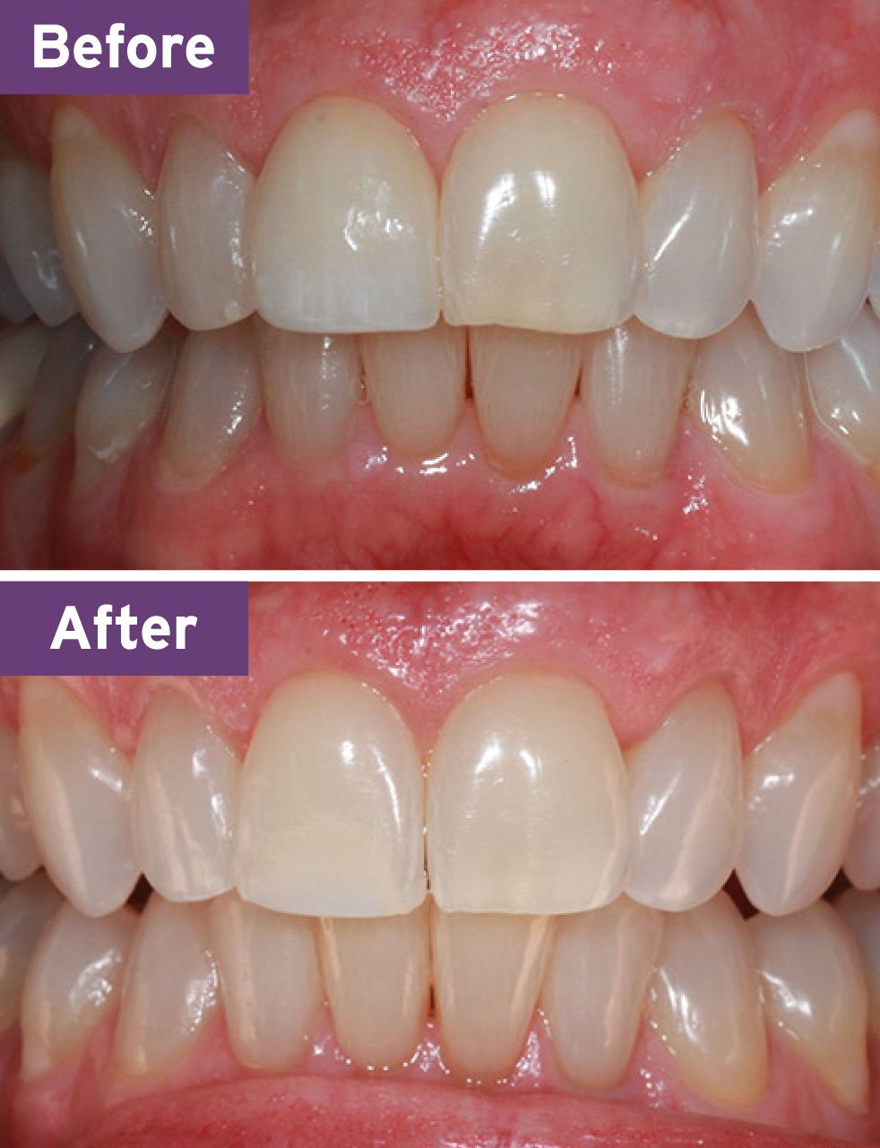 Lynnwood Dentist Smile Gallery
