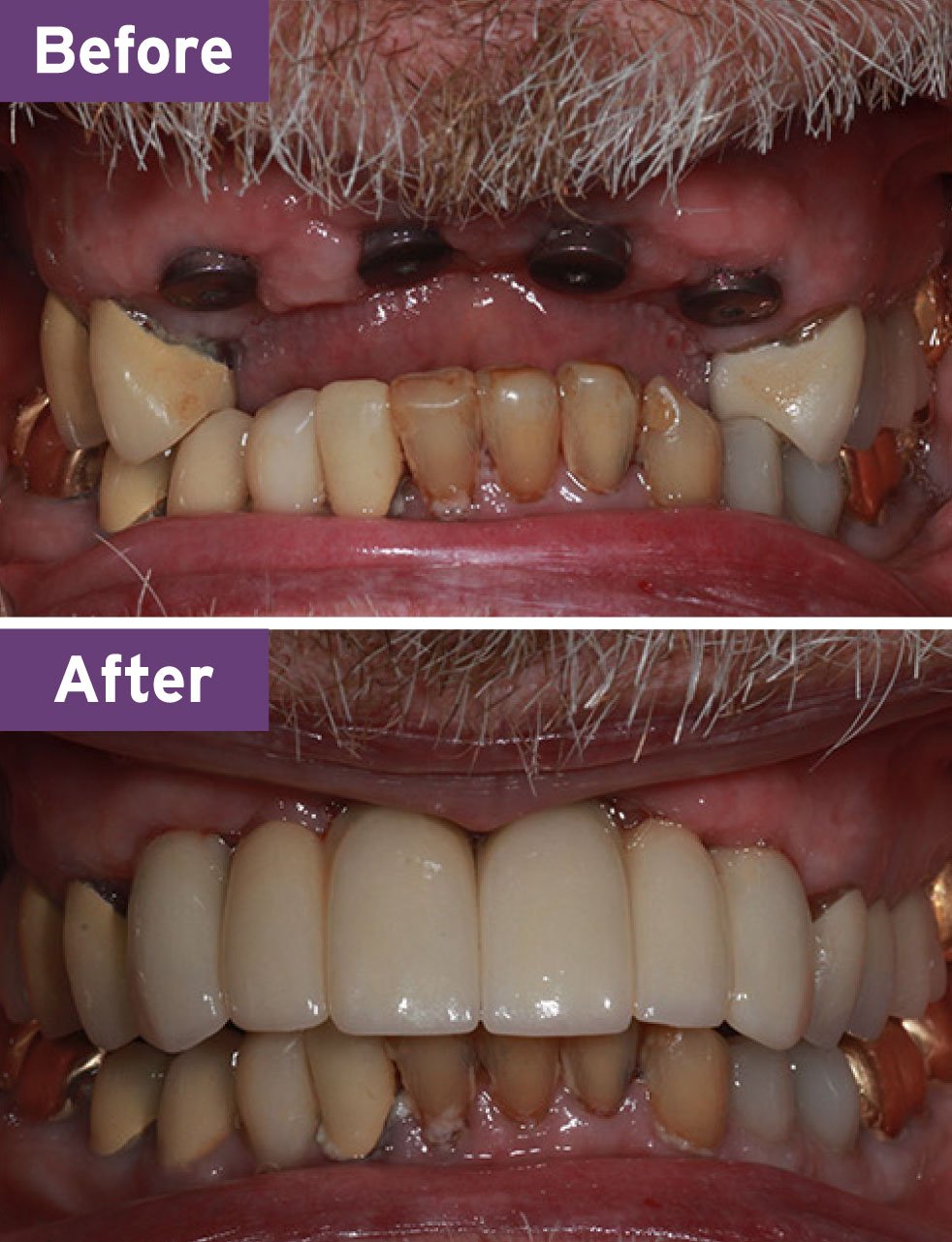Lynnwood Dentist Smile Gallery