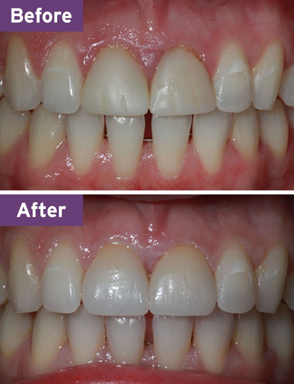 Lynnwood Dentist Smile Gallery