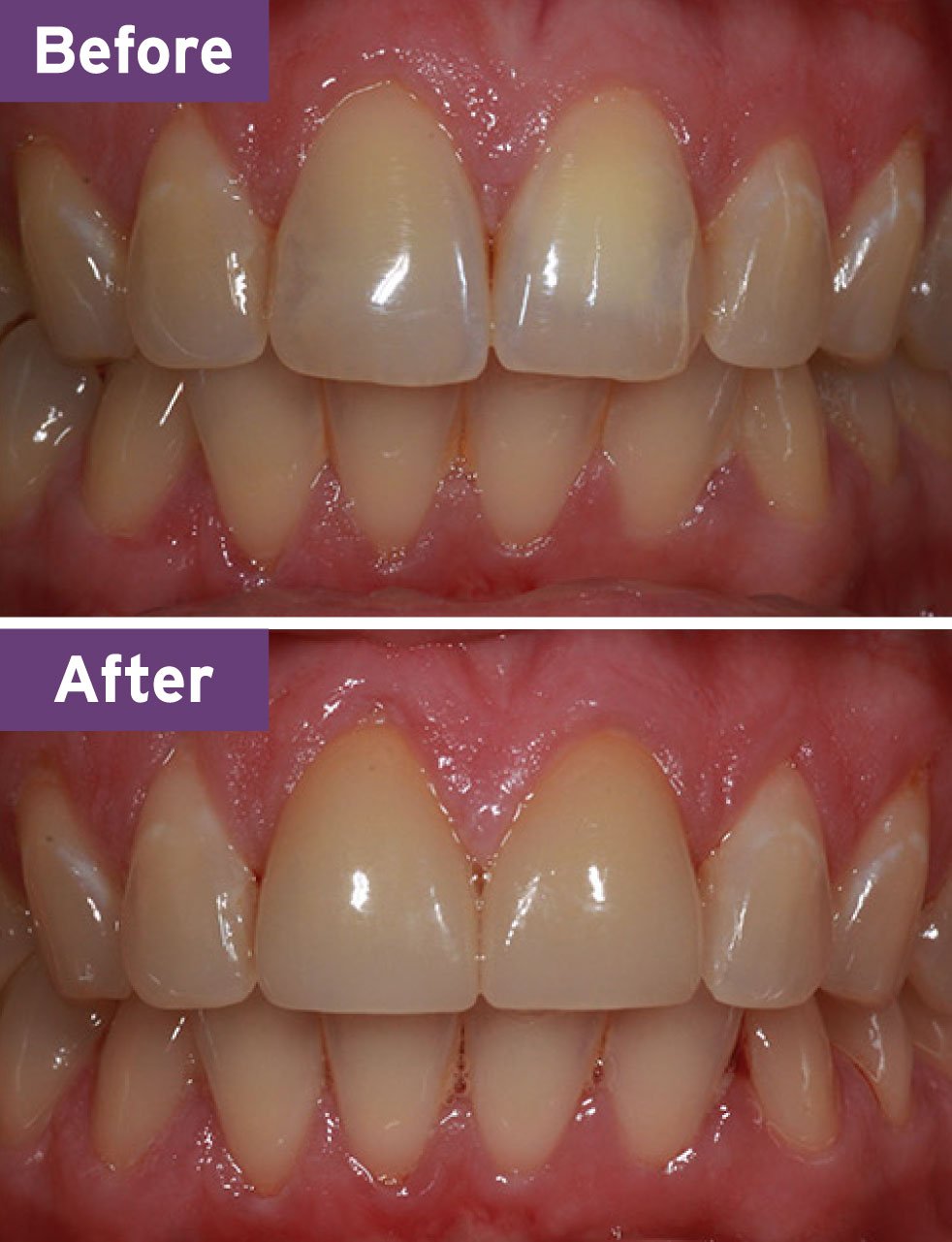 Lynnwood Dentist Smile Gallery