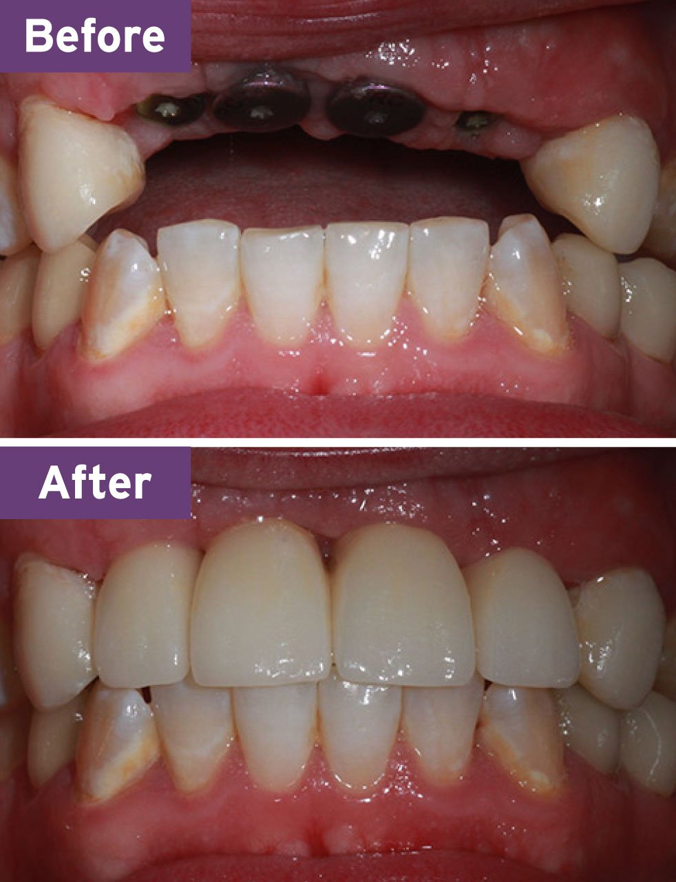 Lynnwood Dentist Smile Gallery