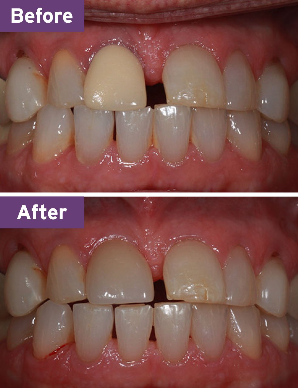 Lynnwood Dentist Smile Gallery