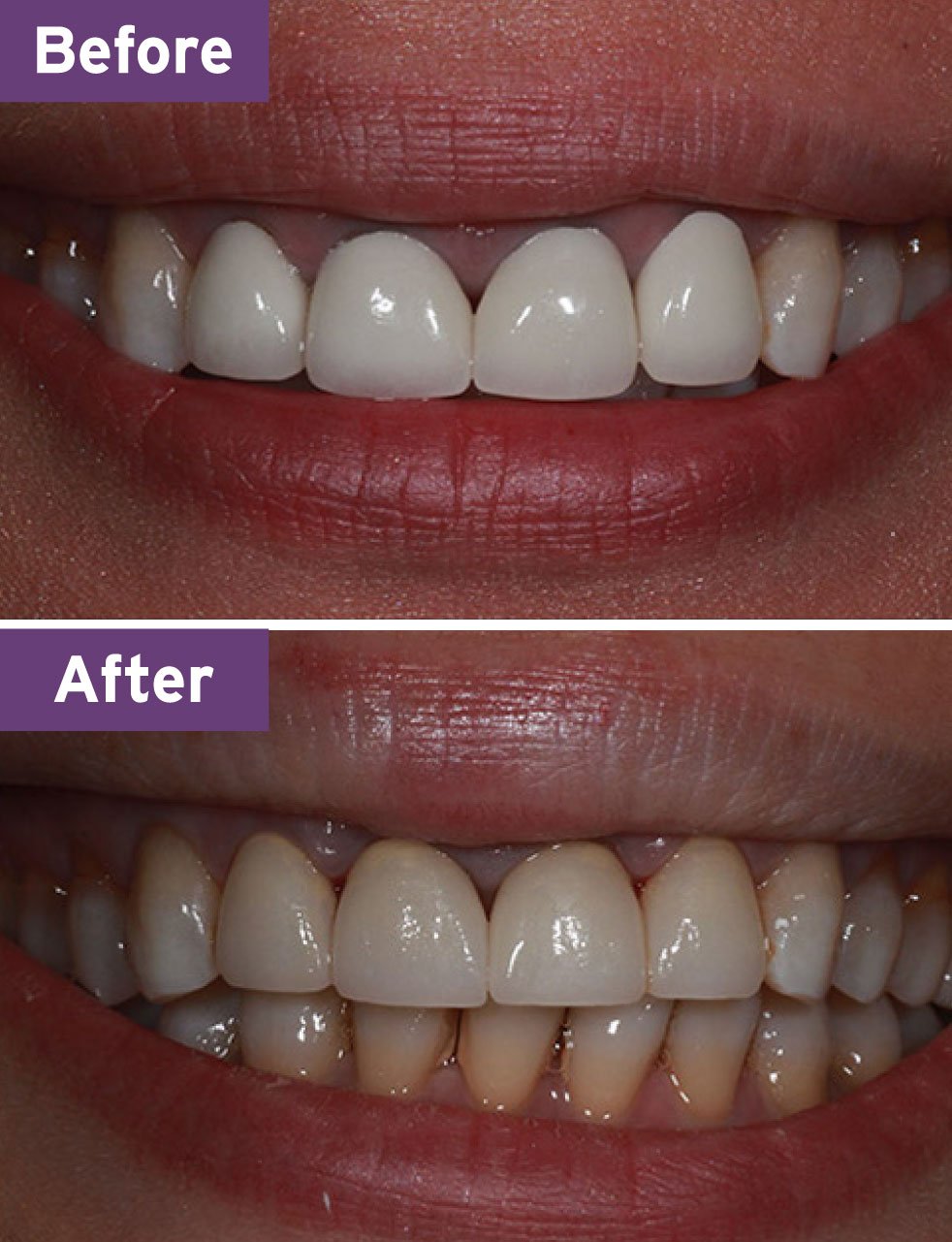 Lynnwood Dentist Smile Gallery