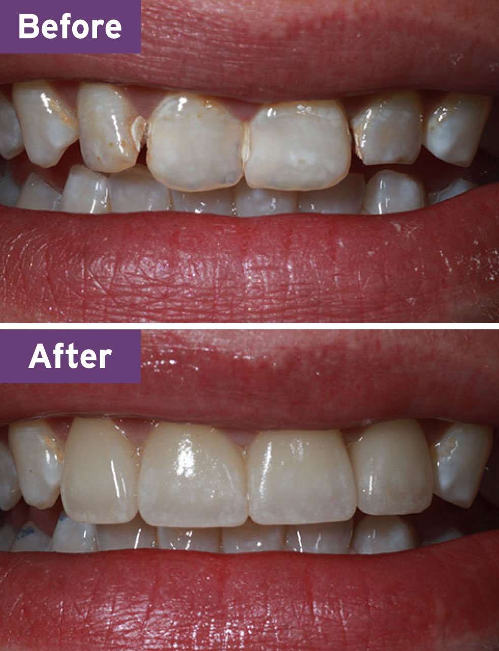 Lynnwood Dentist Smile Gallery