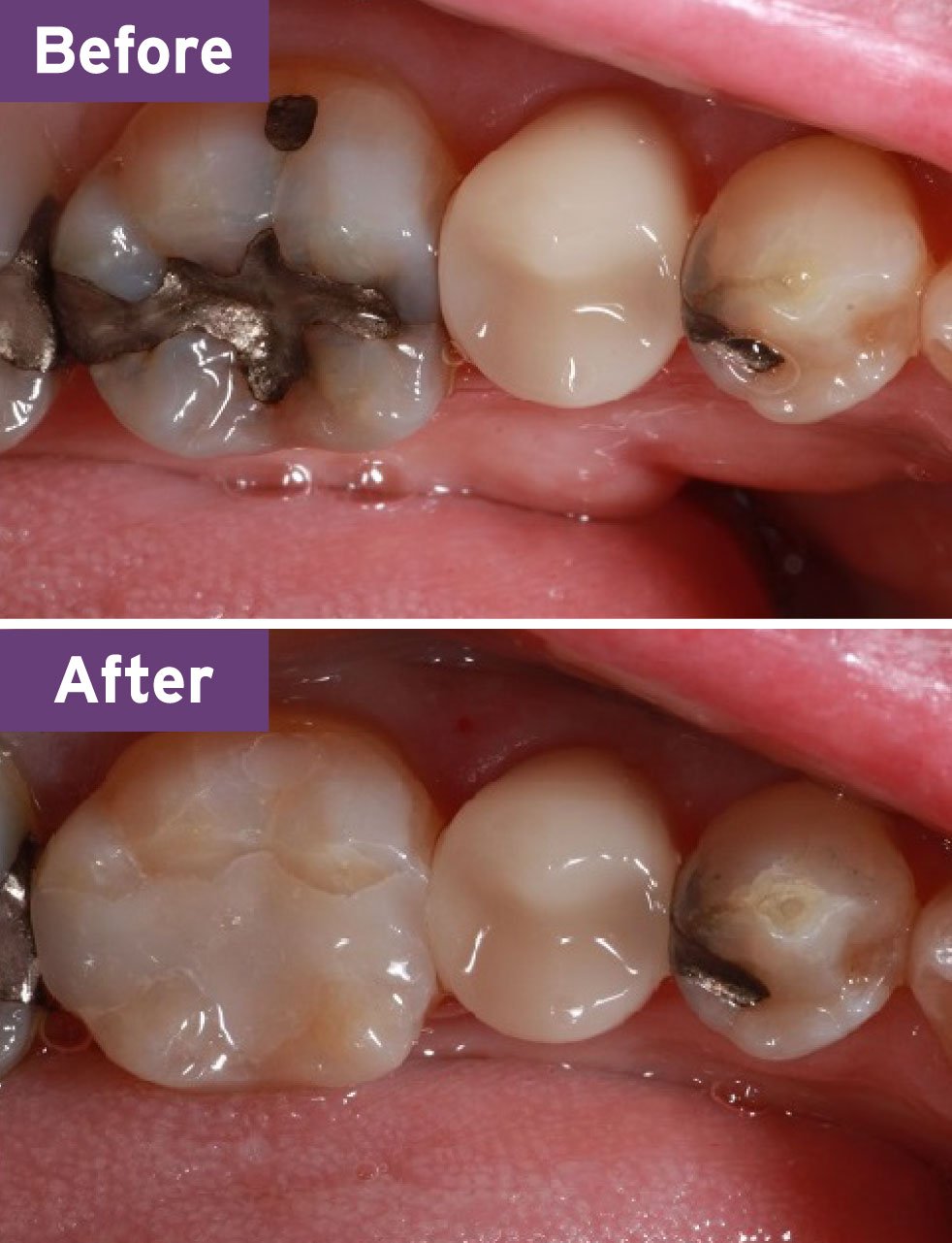 Lynnwood Dentist Smile Gallery