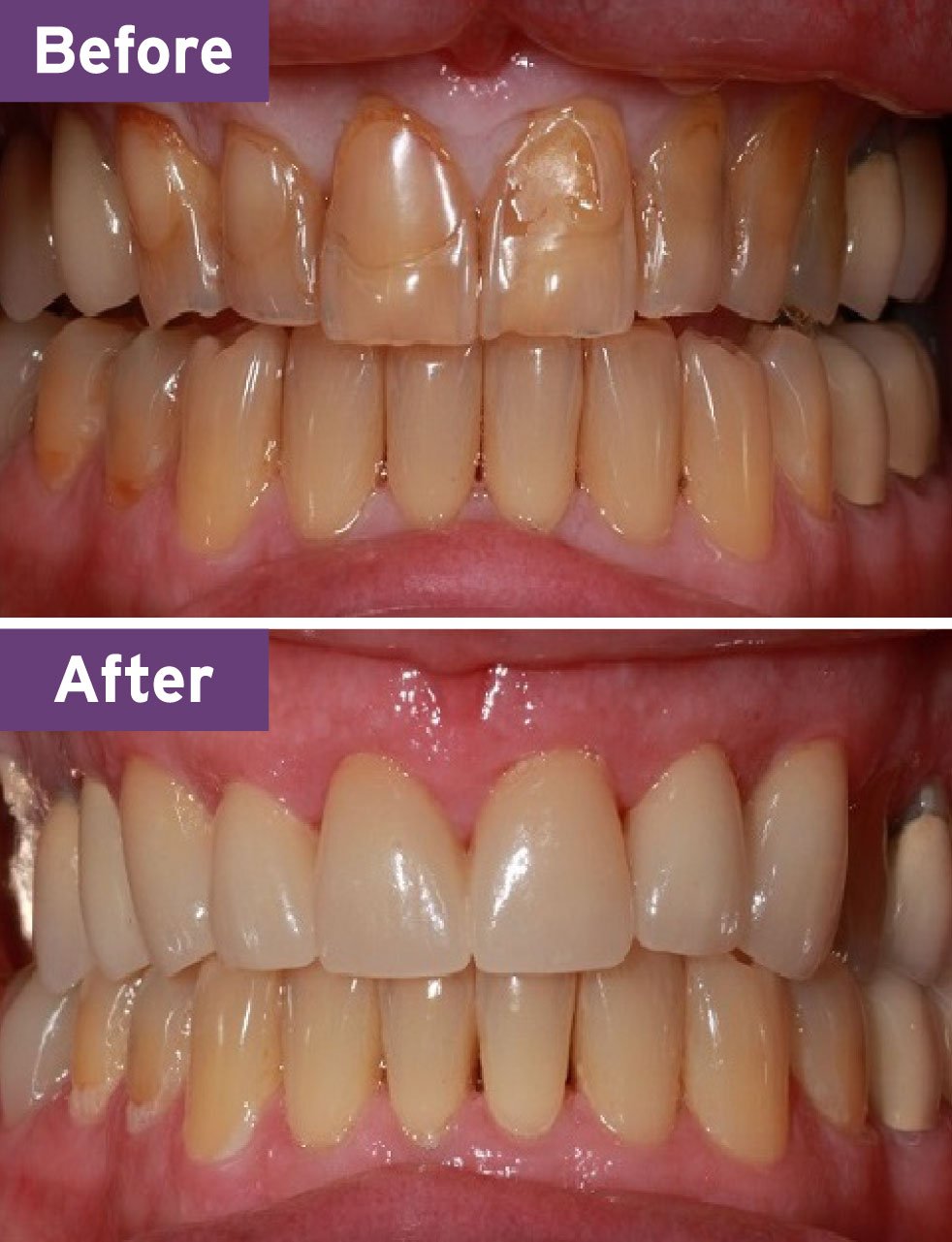 Lynnwood Dentist Smile Gallery